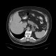Lipoma of duodenum, adenoma of adrenal gland: CT - Computed tomography
